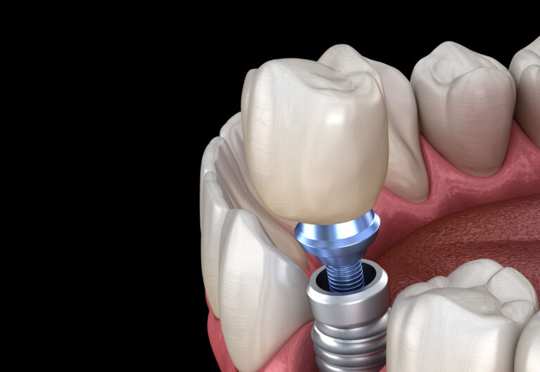dental implant model