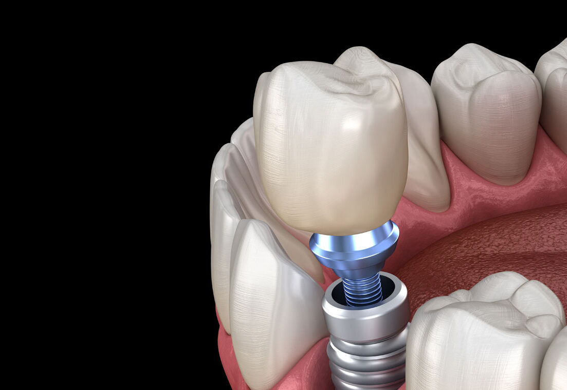 dental implant model
