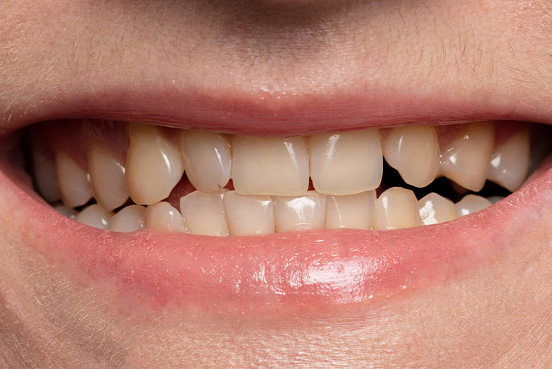 Before procedure