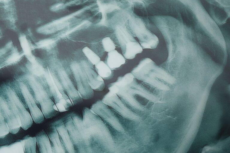 Close up shot of a dentist's hands carefully fitting a prosthetic tooth onto a dental implant, showcasing the precision involved in restoring a patient's smile. No text on image.